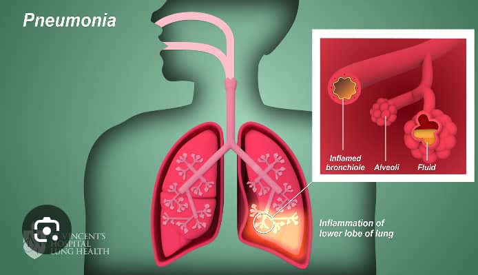 Impact Health Organization Urges South Sudan to Launch Life-Saving PCV and Rotavirus Vaccines on World Pneumonia Day